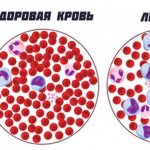 Blood test for leukemia