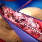 Angiojet is an effective method for removing venous blood clots
