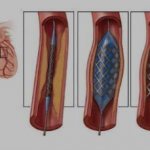 Angioplasty and stenting of arteries
