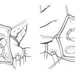Аннулопластика рехстворчатого клапана на жестком кольце Carpentier-Edwards