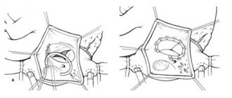 Аннулопластика рехстворчатого клапана на жестком кольце Carpentier-Edwards
