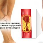 Атеросклероз ног