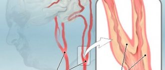 Plaques in the carotid arteries are the most common cause of ischemic stroke