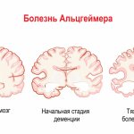 Alzheimer&#39;s disease.jpg