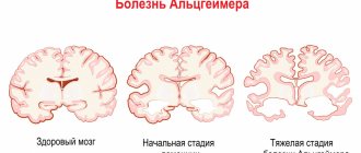 Alzheimer&#39;s disease.jpg
