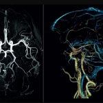 clear picture of cerebral vessels