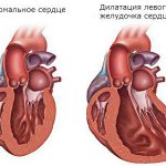 Dilatation of the left ventricle of the heart