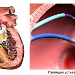 Efficacy of cryoablation pulmonary vein isolation in patients with atrial fibrillation