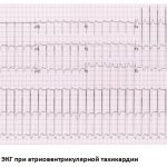 ECG tachycardia