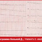 Electrocardiogram of patient D.