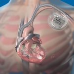 Pacemaker saves lives