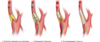 Stages of stent installation