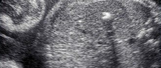 Hyperechogenicity in the fetal heart
