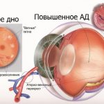 Hypertensive retinal angiopathy