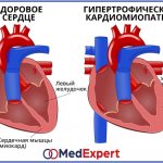 Hypertrophic cardiomyopathy; Symptoms of HCM; Treatment of hypertrophic cardiomyopathy 