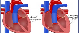 Гипертрофическая кардиомиопатия; Симптомы ГКМП; Лечение гипертрофической кардиомиопатии