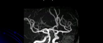 Гипоплазия левой артерии головного мозга