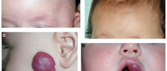 Deep-lying vessels - infantile hemangioma on the forehead