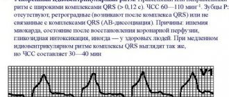 Idioventricular rhythm on the ECG. What does this mean, photos, causes and treatment 