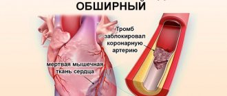 Инфаркт миокарда без зубца Q