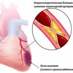 Image 1: Coronary heart disease - Family Doctor clinic