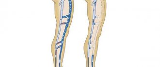 What operations are performed for varicose veins in the legs?