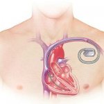 Cardioverter-defibrillator