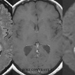 Brain cysts on MRI