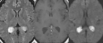 Brain cysts on MRI