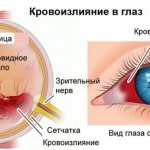 кровоизлияние в глаз