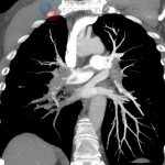 CT angiopulmonography reveals organized thrombi in the pulmonary arteries