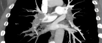 КТ ангиопульмонография позволяет выявить организованные тромбы в легочных артериях