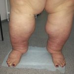 Treatment of lymphedema