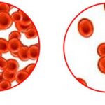 Малокровие и нормальная кровь