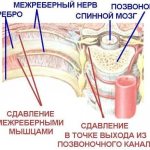 Intercostal neuralgia - Images - Network of clinics JSC Family Doctor
