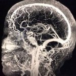MRI angiography of cerebral vessels