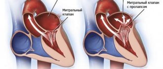 Mitral valve insufficiency (mitral regurgitation)