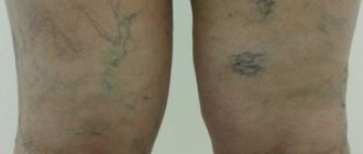 Several options for spider veins