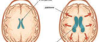 Норма и гидроцефалия головного мозга