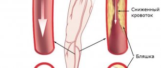 Облитерирующий атеросклероз артерий нижних конечностей 2.jpg