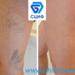 Common location of spider veins on the legs