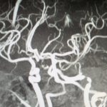 Cerebral vascular lesions on MRI
