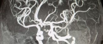 Поражение сосудов головного мозга на МРТ