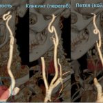 Различные виды патологической извитости сонных артерий