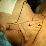Scheme of jugular vein catheterization