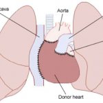 Схема пересадки сердца