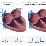Схема распространения нервных импульсов в норме и при фибрилляции сердца