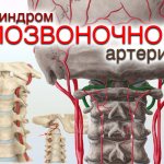 Vertebral artery syndrome
