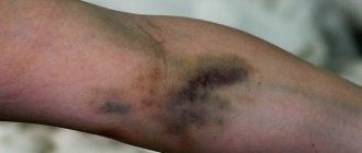 Bruises after IV placement