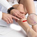 Сосудистые звездочки на ногах - причины и лечение